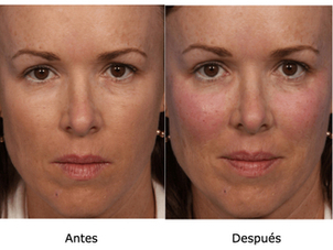 Resultados aumento pómulos