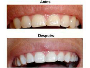 limpieza dental