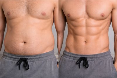 Antes y después de Lipoescultura