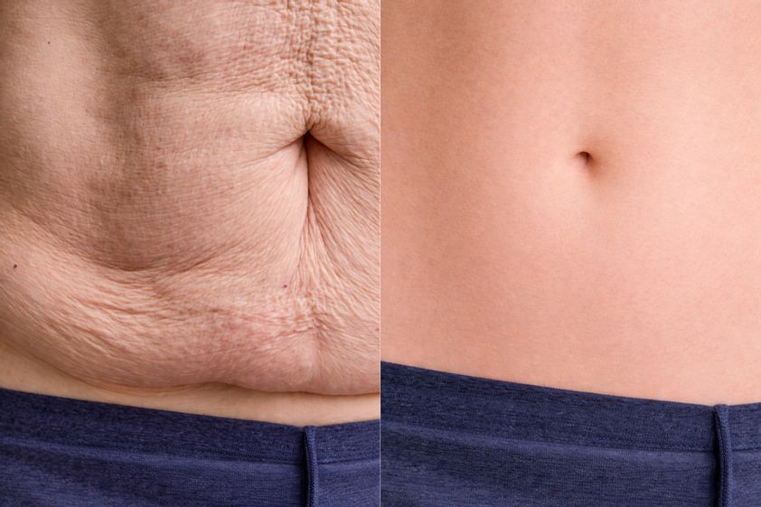 Abdominoplastía