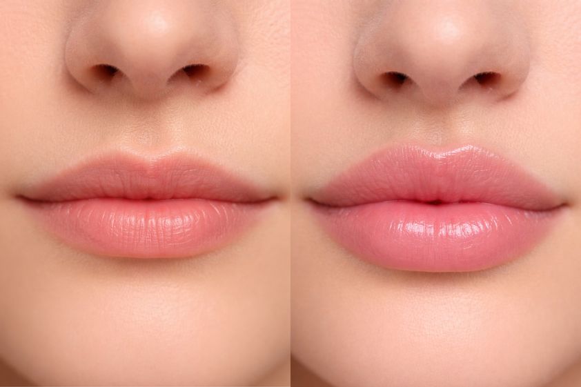Aumento de labios