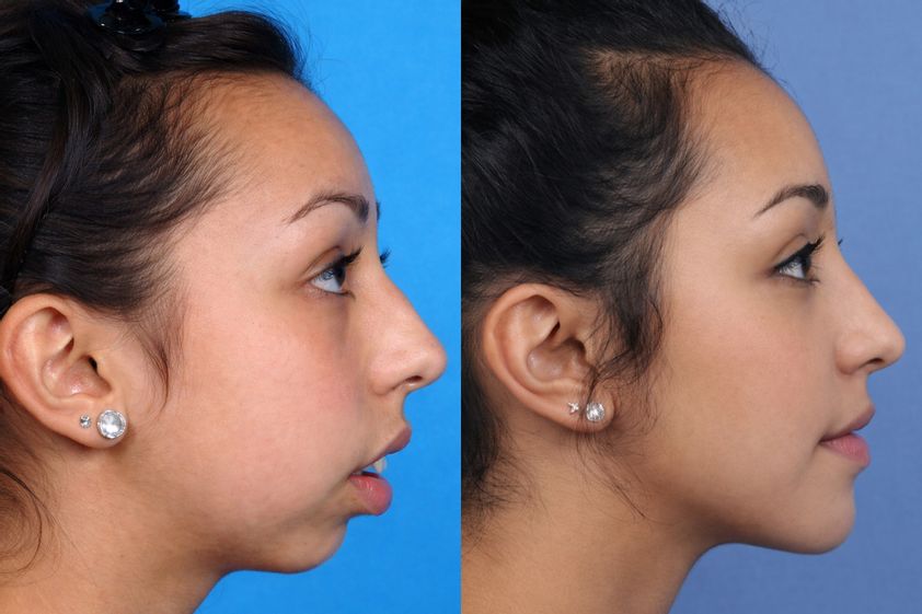 Mentoplastia