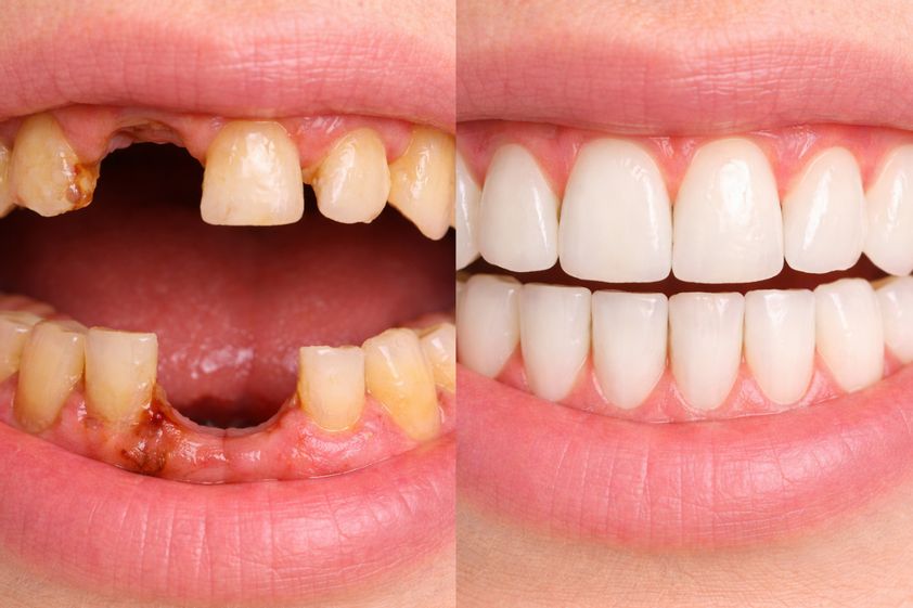 Prótesis dentales