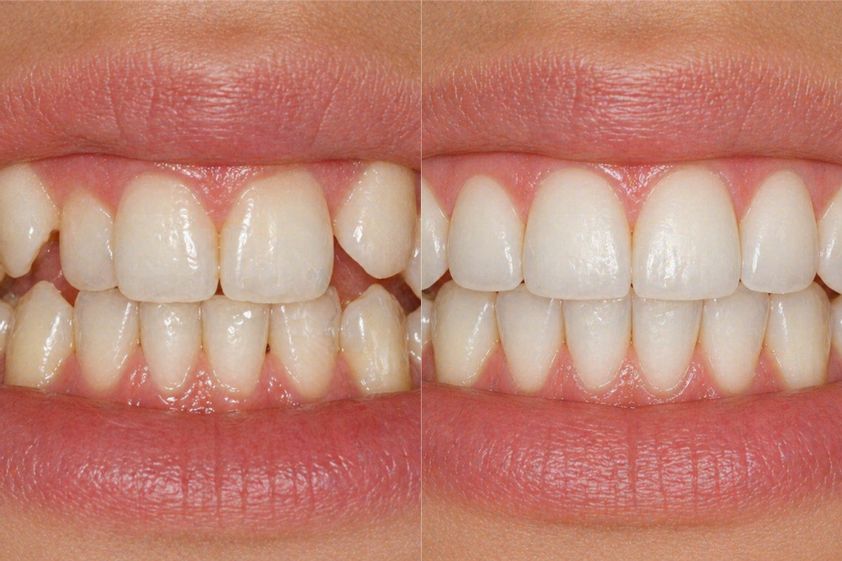 Reconstrucción dental