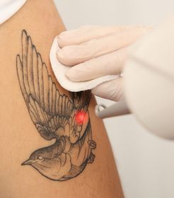 Borrar tatuajes