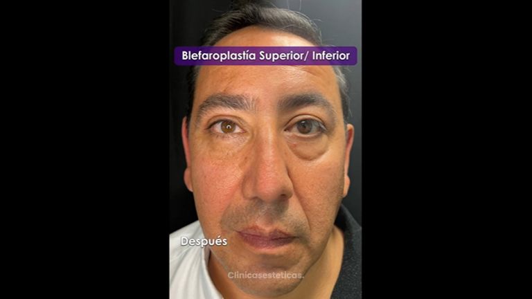 Blefaroplastia - Medicina Estética Integral MD