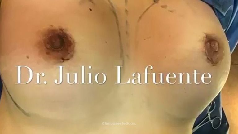 Aumento mamario con implantes. Dr. Julio Lafuente