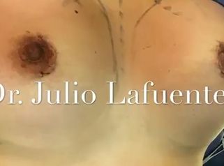Aumento mamario con implantes. Dr. Julio Lafuente