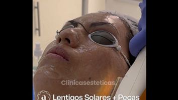 Lentigos solares y pecas - Amanda Beauty