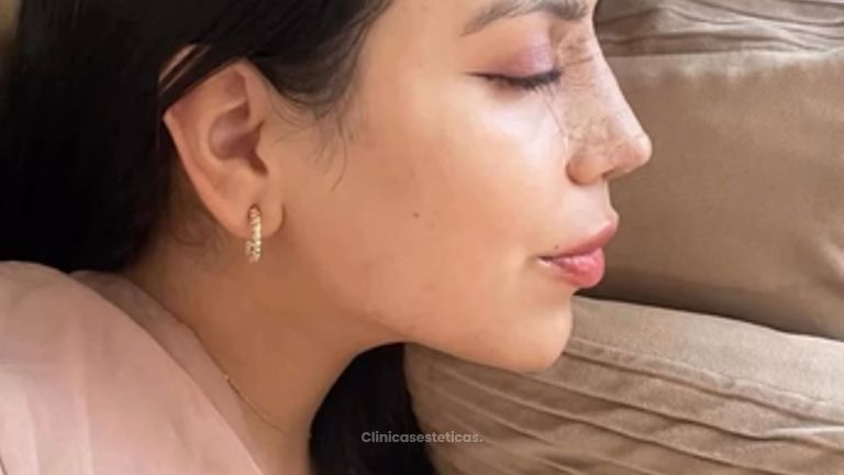 Rinoplastia Ultrasonica - Dra. Angélica Sifontes Muñoz