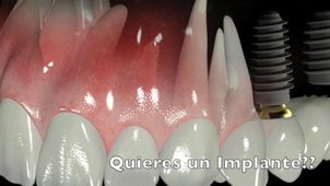 ¿Qué tipos de implantes dentales existen?