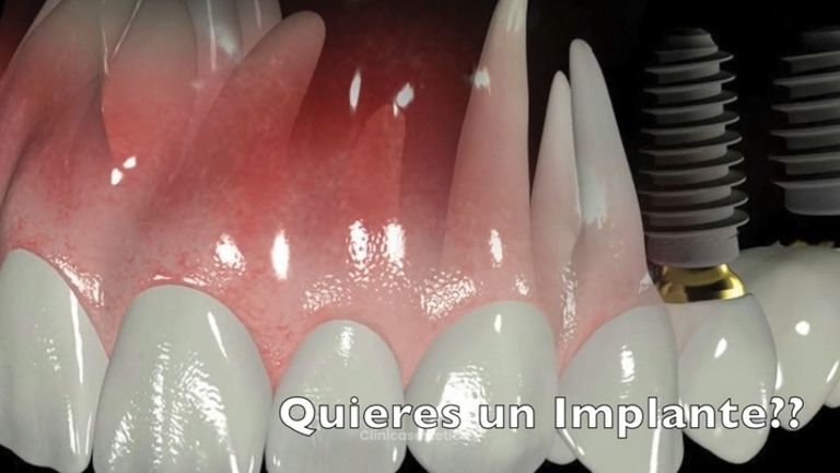 Implantes dentales