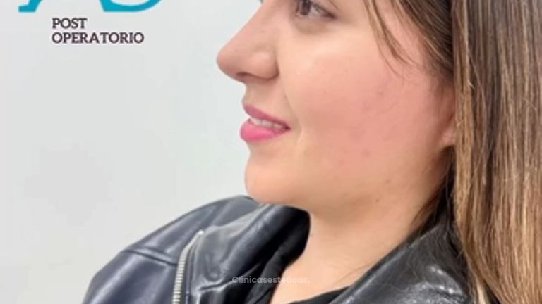 Rinoplastia Ultrasonica - Dra. Angélica Sifontes Muñoz