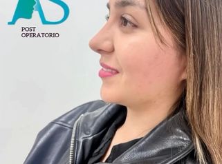 Rinoplastia Ultrasonica - Dra. Angélica Sifontes Muñoz