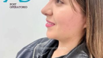 Rinoplastia Ultrasonica - Dra. Angélica Sifontes Muñoz