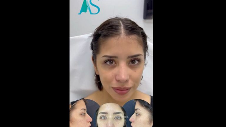 Rinoplastia - Dra. Angelica Sifontes Muñoz
