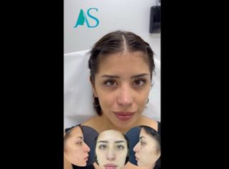 Rinoplastia - Dra. Angelica Sifontes Muñoz
