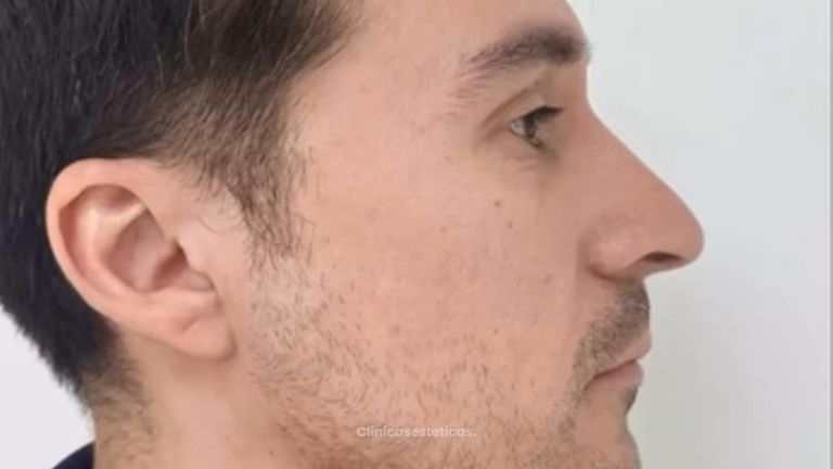 Rinoplastia Ultrasonica - Dra. Angélica Sifontes Muñoz