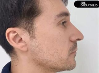 Rinoplastia Ultrasonica - Dra. Angélica Sifontes Muñoz