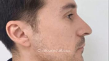 Rinoplastia Ultrasonica - Dra. Angélica Sifontes Muñoz