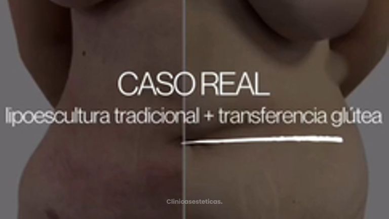 Lipoescultura - Dr Christian Salem Zamorano