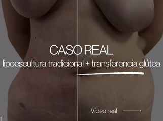 Lipoescultura - Dr Christian Salem Zamorano