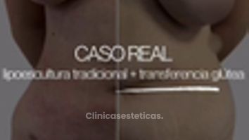 Lipoescultura - Dr Christian Salem Zamorano