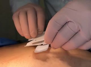 LifeChip Reposición Hormonal - Clinica Bendov