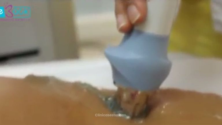 Acaba para siempre con la celulitis