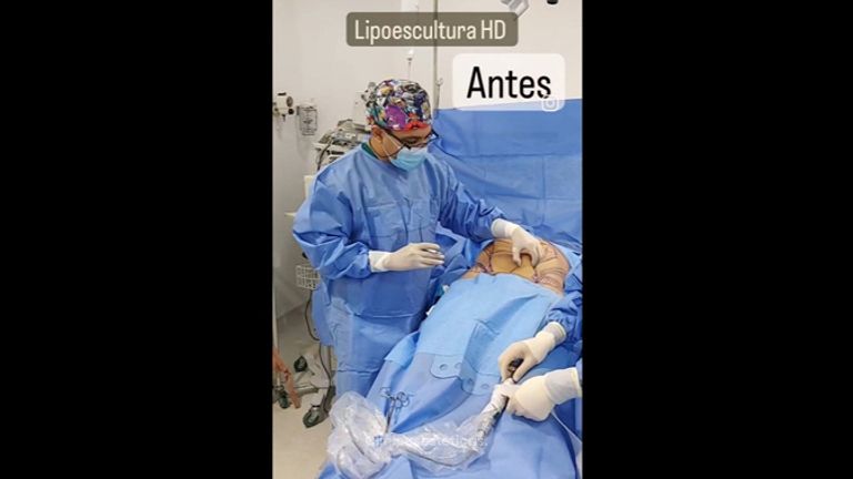 Liposucción - Cirugía Plástica Dieppa
