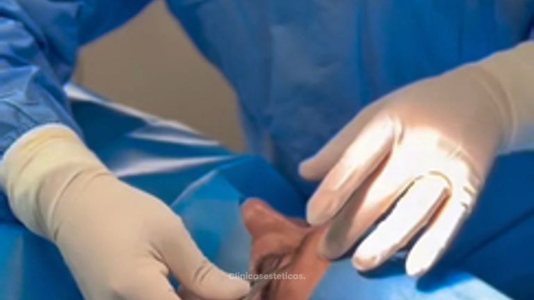 Blefaroplastia - Dr. Marcelo Fonseca Canteros