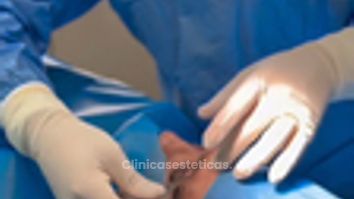 Blefaroplastia - Dr. Marcelo Fonseca Canteros