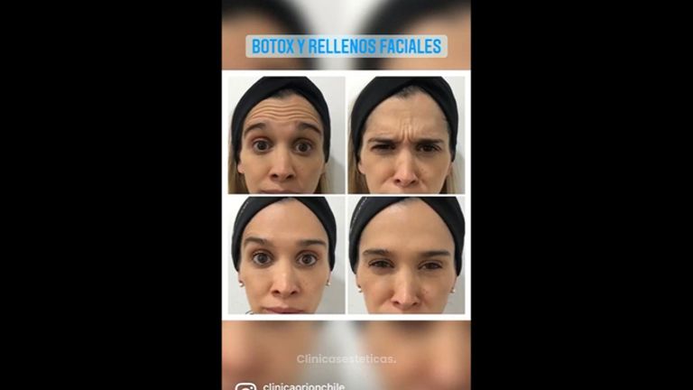 Toxina botulínica y rellenos faciales - Clínica Orión