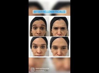 Toxina botulínica y rellenos faciales - Clínica Orión