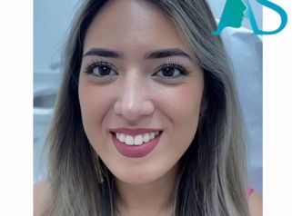 Rinoplastia - Dra. Angelica Sifontes Muñoz