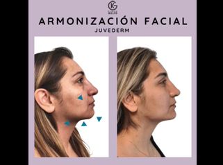 Armonización facial - Clínica Dra. Kelly Gulfo