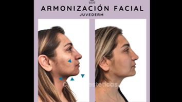 Armonización facial - Clínica Dra. Kelly Gulfo