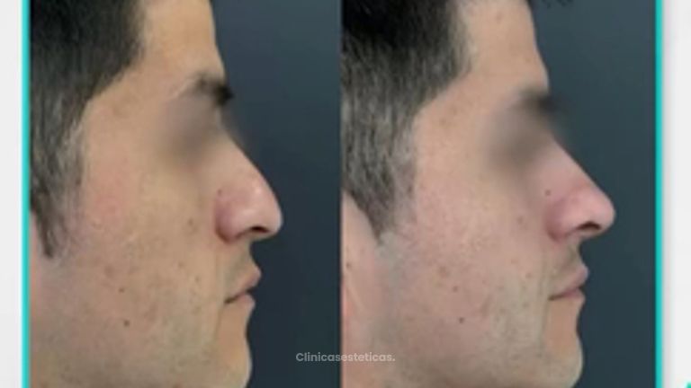 Rinomodelación - Clinica Visage