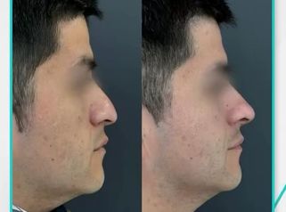 Rinomodelación - Clinica Visage