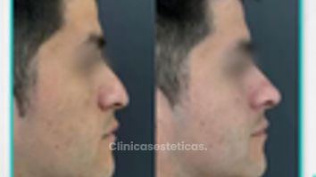 Rinomodelación - Clinica Visage
