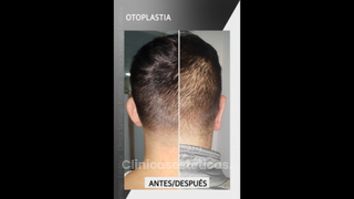 Otoplastia - Clínica Santiago Estética