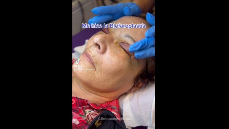 Blefaroplastia - Medicina Estética Integral MD