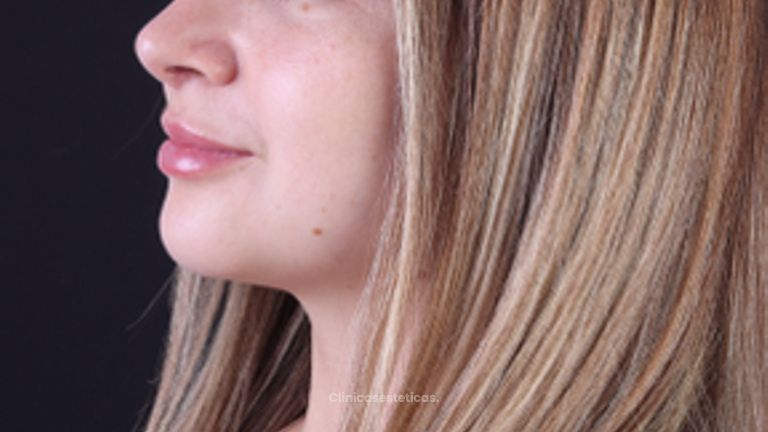 Full Face - Dra. Evelyn Schneider M.