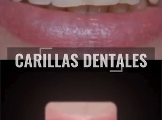 Carillas Dentales - Clínica Visage