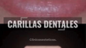 Carillas Dentales - Clínica Visage