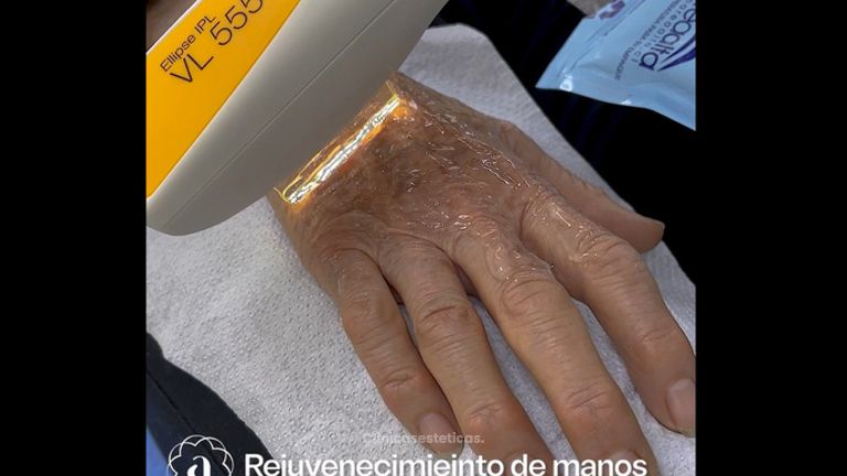 Rejuvenecimiento de manos - Amanda Beauty