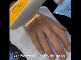 Rejuvenecimiento de manos - Amanda Beauty
