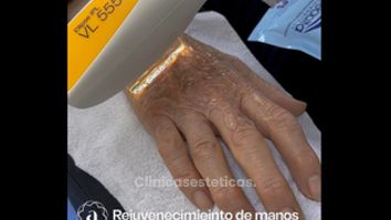 Rejuvenecimiento de manos - Amanda Beauty