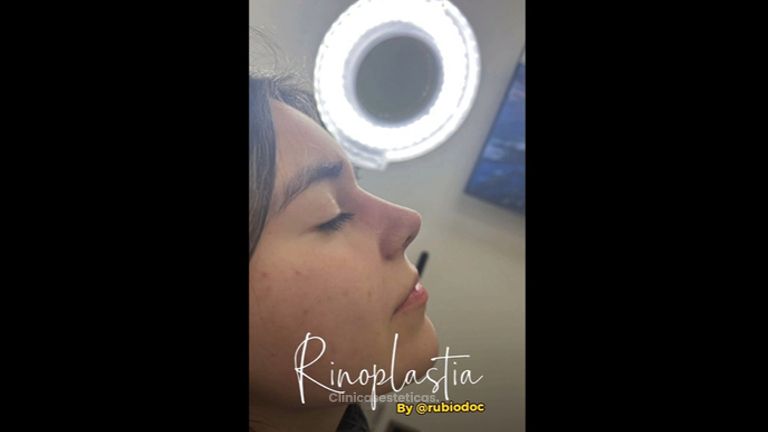 Rinoplastia - Dr. Alvaro Rubio González