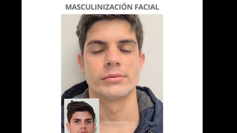 Masculinización Facial